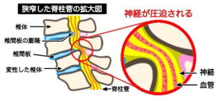 腰部脊柱管狭窄症の説明